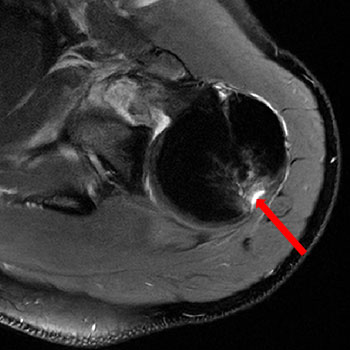 Hill Sachs Läsion am dorsalen Humeruskopf im MRT