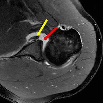 Bankart Läsion der Schulter im MRT